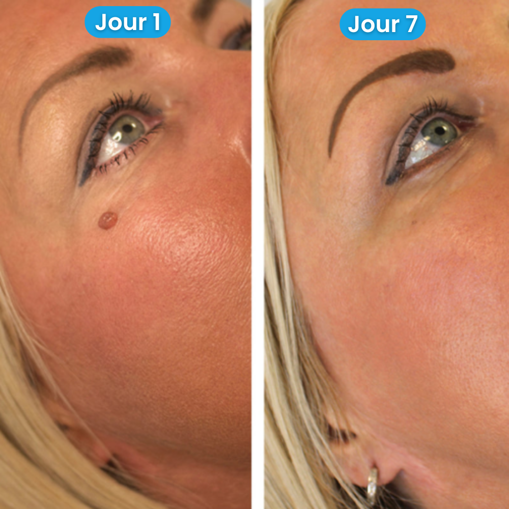 Kit Dermapure™ - Adieu les imperfections