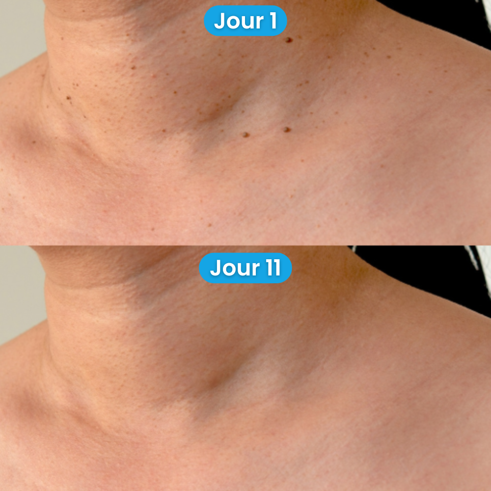 Kit Dermapure™ - Adieu les imperfections