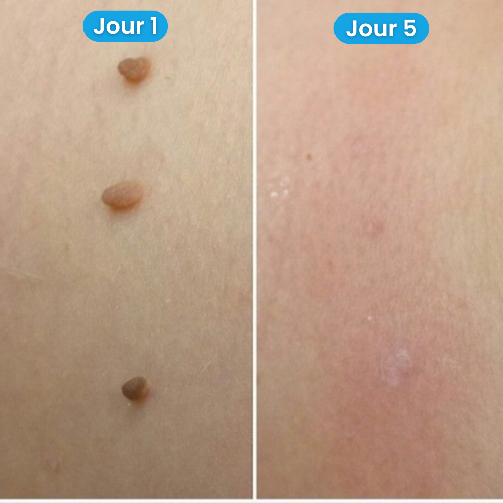 Kit Dermapure™ - Adieu les imperfections
